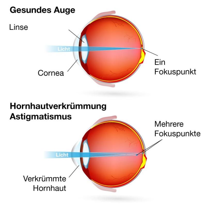 Hornhautverkrümmung Augenzentrum Nürnberg
