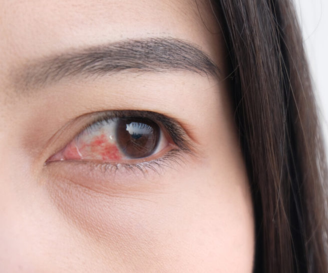 Detailfoto entzündetes rotes Auge