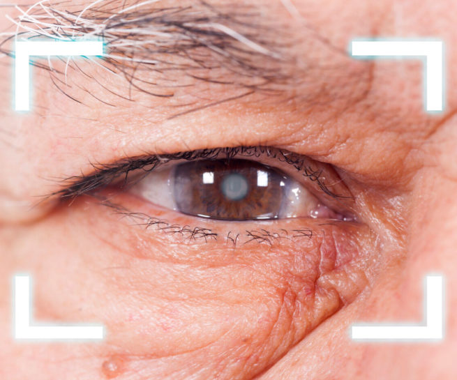 Foto Auge mit Grauem Star