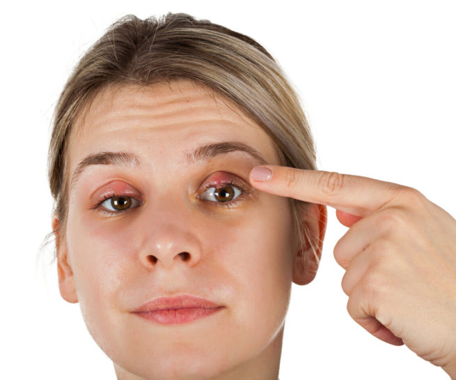 Augenzentrum Nürnberg, Entzündete Augenlider bei einer jungen Frau