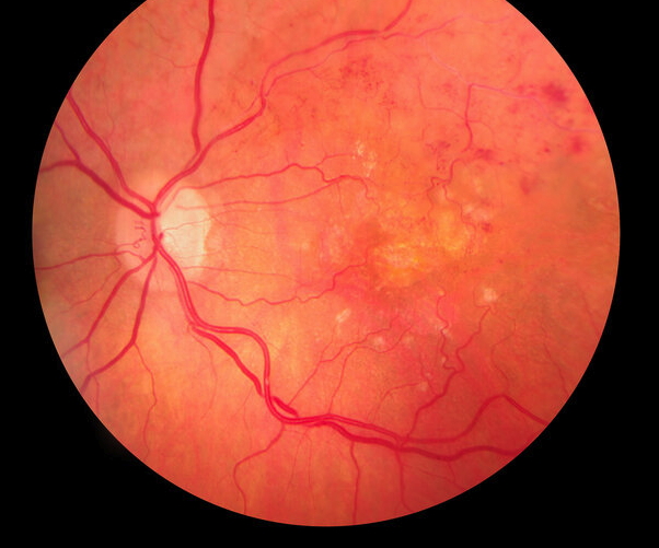 Detailfoto Retina mit Makuladegeneration